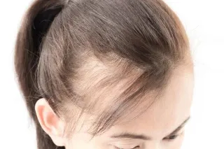 Understanding and Managing a Receding Hairline