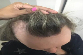 Frontal Fibrosing Alopecia: Understanding Causes, Symptoms, and Treatments