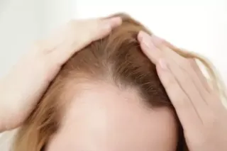 Understanding Traction Alopecia: Causes, Symptoms, and Solutions