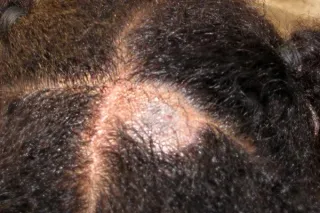 Understanding Scalp Scaling with Ringworm: Causes, Symptoms, and Treatments