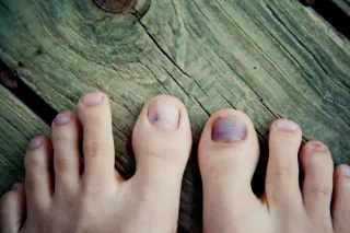 Discolored Toenails? It Might Not Be Fungus! Sorting Out Onychomycosis vs. Psoriasis