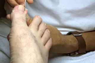 Recognising the Signs of Infection from Ingrown Toenails