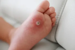 Preventing Plantar Warts: Essential Tips for Healthy, Wart-Free Feet