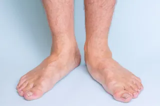 Flat Feet and Arch Pain: What You Should Know