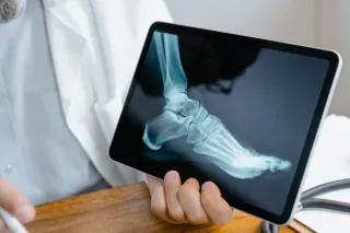 What Is Charcot Foot? A Simple Guide for Diabetics