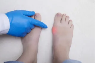 How to Tell if That Lump on Your Foot Is a Ganglion Cyst
