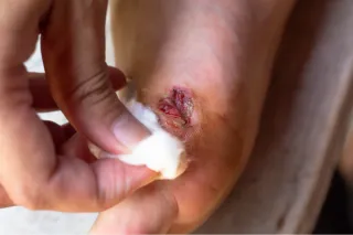 Foot Wounds That Won’t Heal? Don’t Wait to Get Help