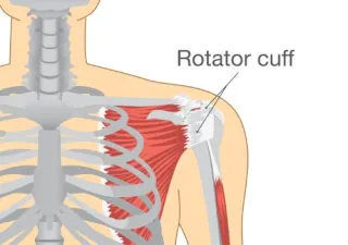 What is a Rotator Cuff Injury & How Can Chiropractic Care Help?