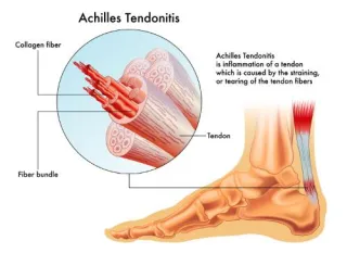 How to Overcome Achilles Tendonitis Using Chiropractic