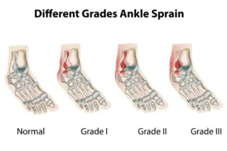 The 3 Grades of An Ankle Sprain & How Chiropractic Can Help