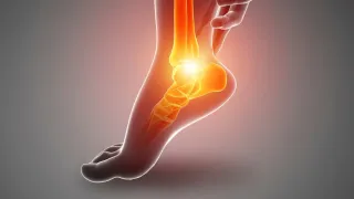 Will PLANTAR FASCIITIS go away on its own?