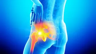 How to Get Immediate Relief from Sciatica Pain?