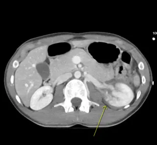 Renal Trauma