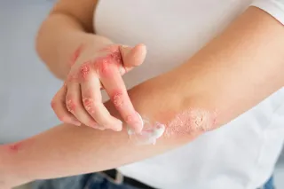 How to Manage Allergic Reactions with First Aid