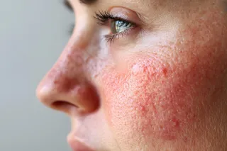How I cured my Rosacea