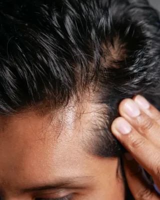 How Botox Relieves Migraines, Headaches & TMJ Pain in Atlanta