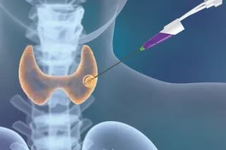 Mejorando el Tratamiento Médico con Ablación por Microondas: Un Avance para las Condiciones de Tiroides