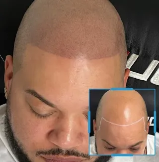What is Scalp Micropigmentation?