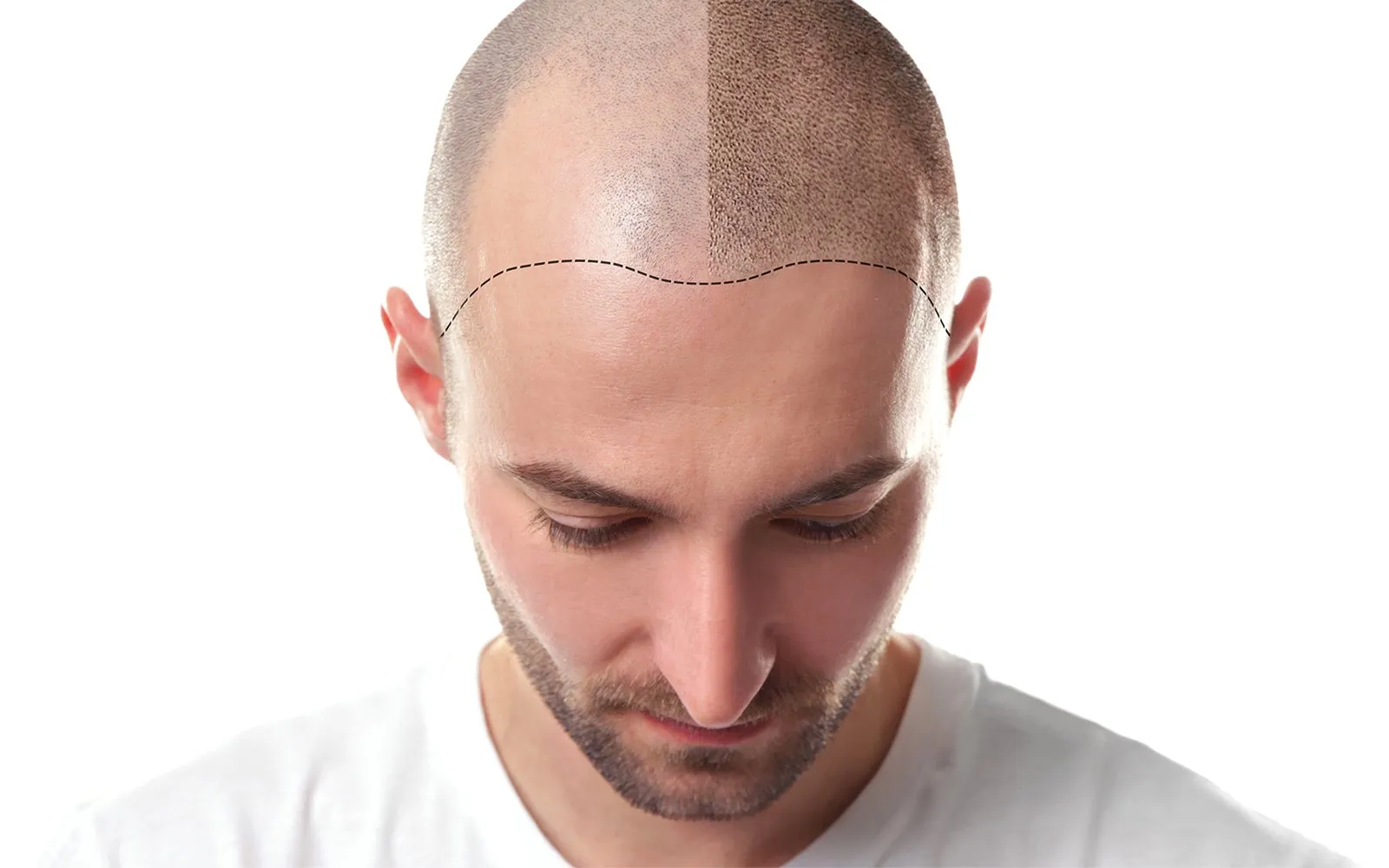 Micro Scalp Pigmentation