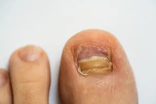 Fungal Nails: What Causes Them and How to Get Rid of Them