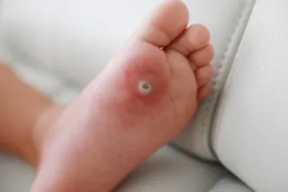 Why Do Some People Get Warts More Than Others?