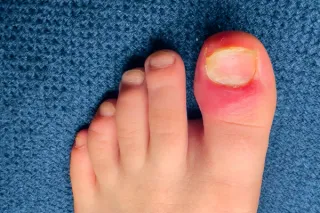 Partial vs Full Nail Removal: Which Ingrown Toenail Surgery Is Right for You in Dublin?