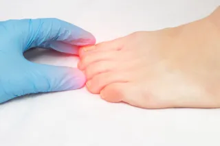 Diabetes and Ingrown Toenails: Why Early Surgery Matters – Dublin Foot Clinic Advice