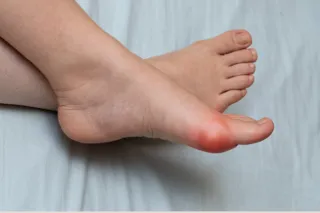 Dublin 9 Podiatrist's Tips for Relieving Bunion Pain at Home