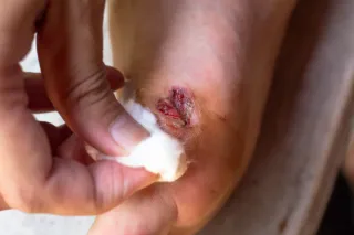 Foot Ulcers and Wound Care: Why Podiatry Matters in Chronic Conditions