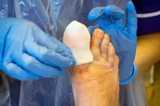Aftercare Essentials: What Dublin Patients Need to Know Post-Ingrown Toenail Surgery