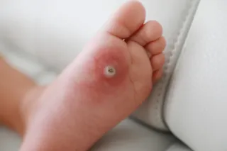 When Over-the-Counter Wart Treatments Fail: What’s Next?