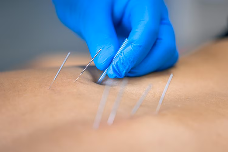 Dry Needling for Postpartum Pain & C-Section Scars | Pelvic Floor PT