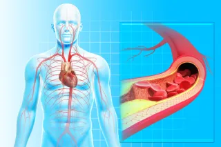 Understanding Apolipoprotein B: A Key Player in Atherosclerosis