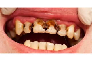 Cavity Fillings: Purpose, Procedure, and
Aftercare