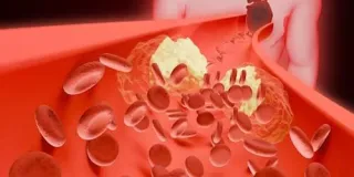 Rethinking Low Cholesterol: A Cardiologist Perspective