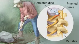 Decoding the Mystery: Understanding Herniated Discs and Their Impact