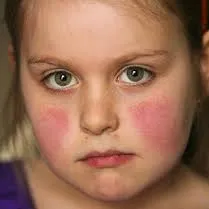 Lupus Eritematoso Juvenil