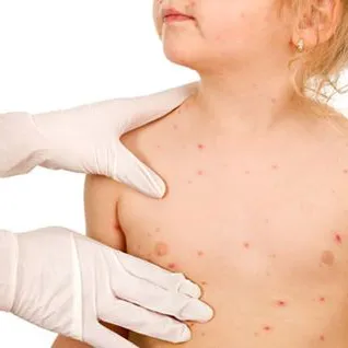 Dermatomiositis juvenil