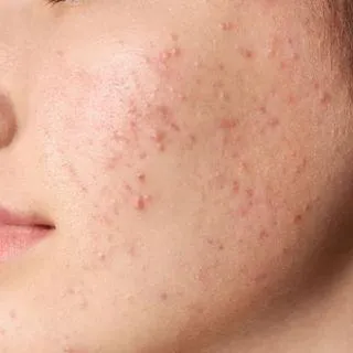 Latest Advances in Acne Treatment