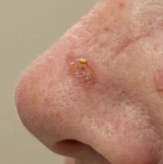 Actinic Keratoses: Understanding Causes, Symptoms and Treatment