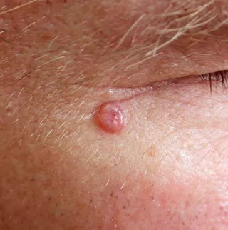 Basal Cell Carcinoma: Symptoms, Risks, and Treatments