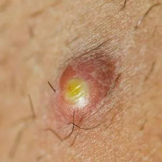 Understanding Boils (Furuncles): Causes, Symptoms, and Treatment Options