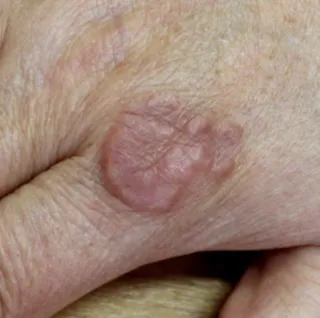 Understand Granuloma Annulare | Leah Michel APRN, FNP-BC