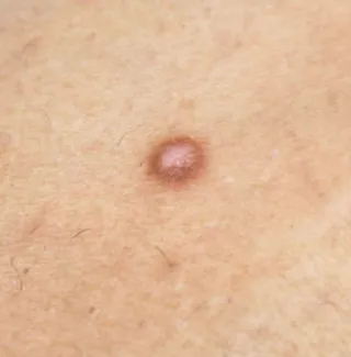 What is Dermatofibromas?
