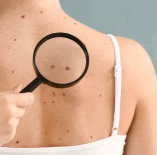 What is a Mole (Nevi)? | Leah Michel APRN, FNP-BC