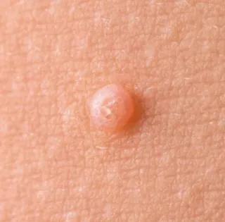 What You Need to Know About Molluscum Contagiosum | My Skin