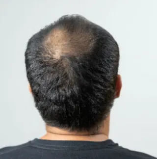 Male Pattern Hair Loss: Symptoms & Causes