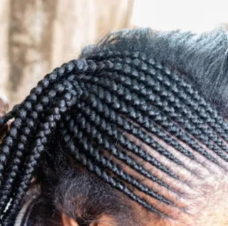 Traction alopecia | Leah Michel APRN, FNP-BC
