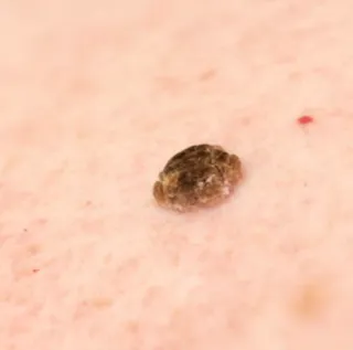 Those Waxy Bumps? Seborrheic Keratosis Explained

| My Skin