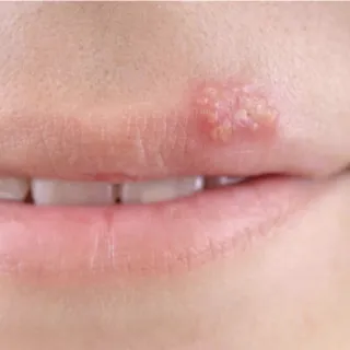 Cold Sores: The Contagious Truth About

Oral Herpes | My Skin
